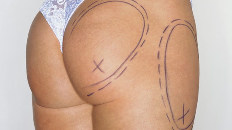 Lifting, rhinoplastie, lipoaspiration : quels résultats dix ans après ?