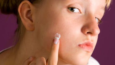 Tratamiento del acné adolescente.