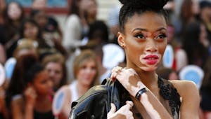 Atteinte de vitiligo, Winnie Harlow est aussi mannequin