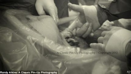 Le bébé tient le doigt du chirurgien lors de la césarienne
