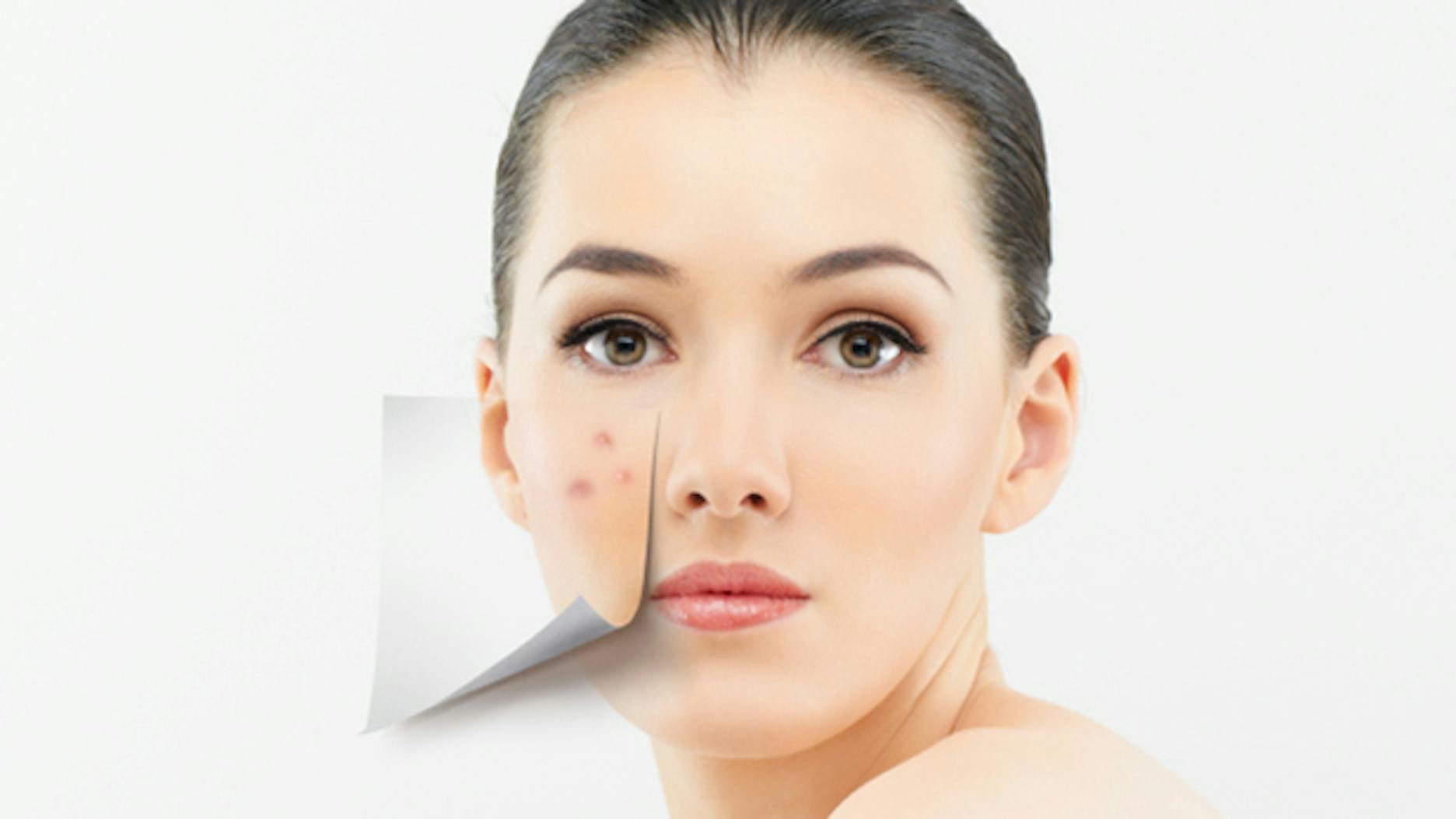 Comment faire disparaître l'acné hormonale ?