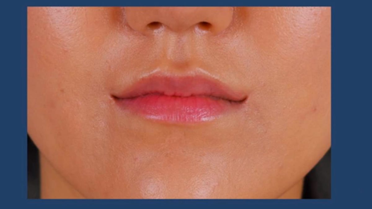 Chirurgie esthétique : se rehausser les lèvres pour un sourire permanent