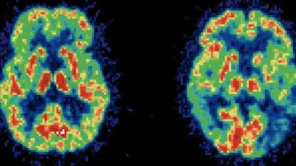 Alzheimer : bientôt un diagnostic simplifié et fiable