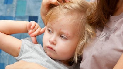 Comment se transmet la varicelle Comment se transmet la varicelle