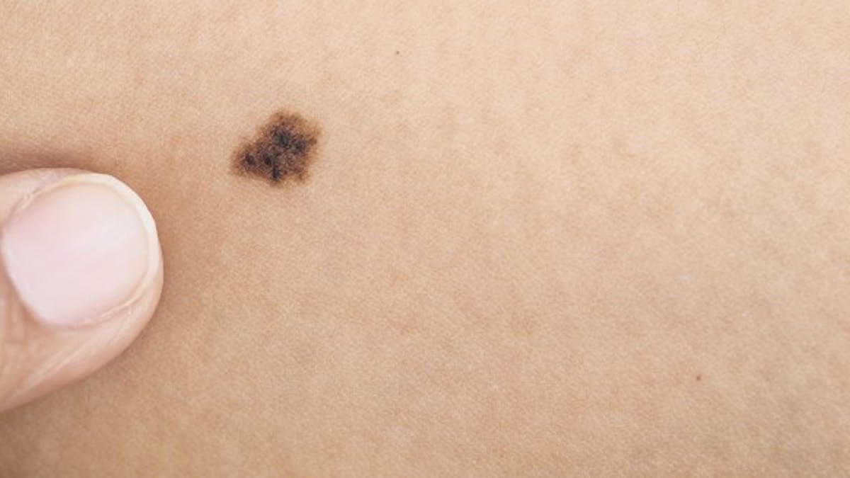 Grains De Beaute Une Journee Pour Faire Le Point Sante Magazine Grains De Beaute Une Journee Pour Faire Le Point Sante Magazine