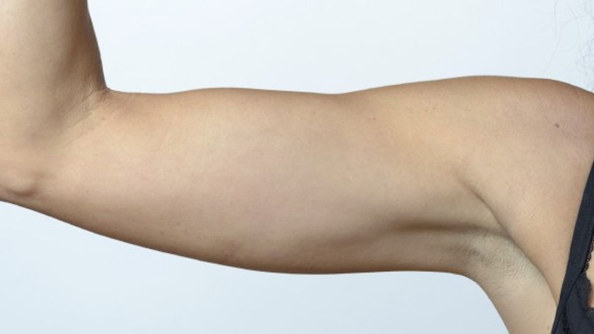 Comment venir à bout de la graisse des bras sans chirurgie