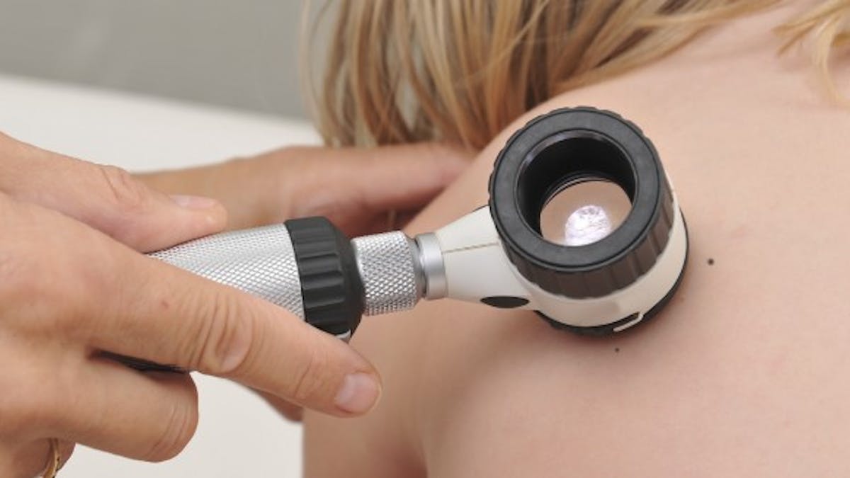 Tout Savoir Sur Les Taches De Naissance Sante Magazine Tout Savoir Sur Les Taches De Naissance Sante Magazine