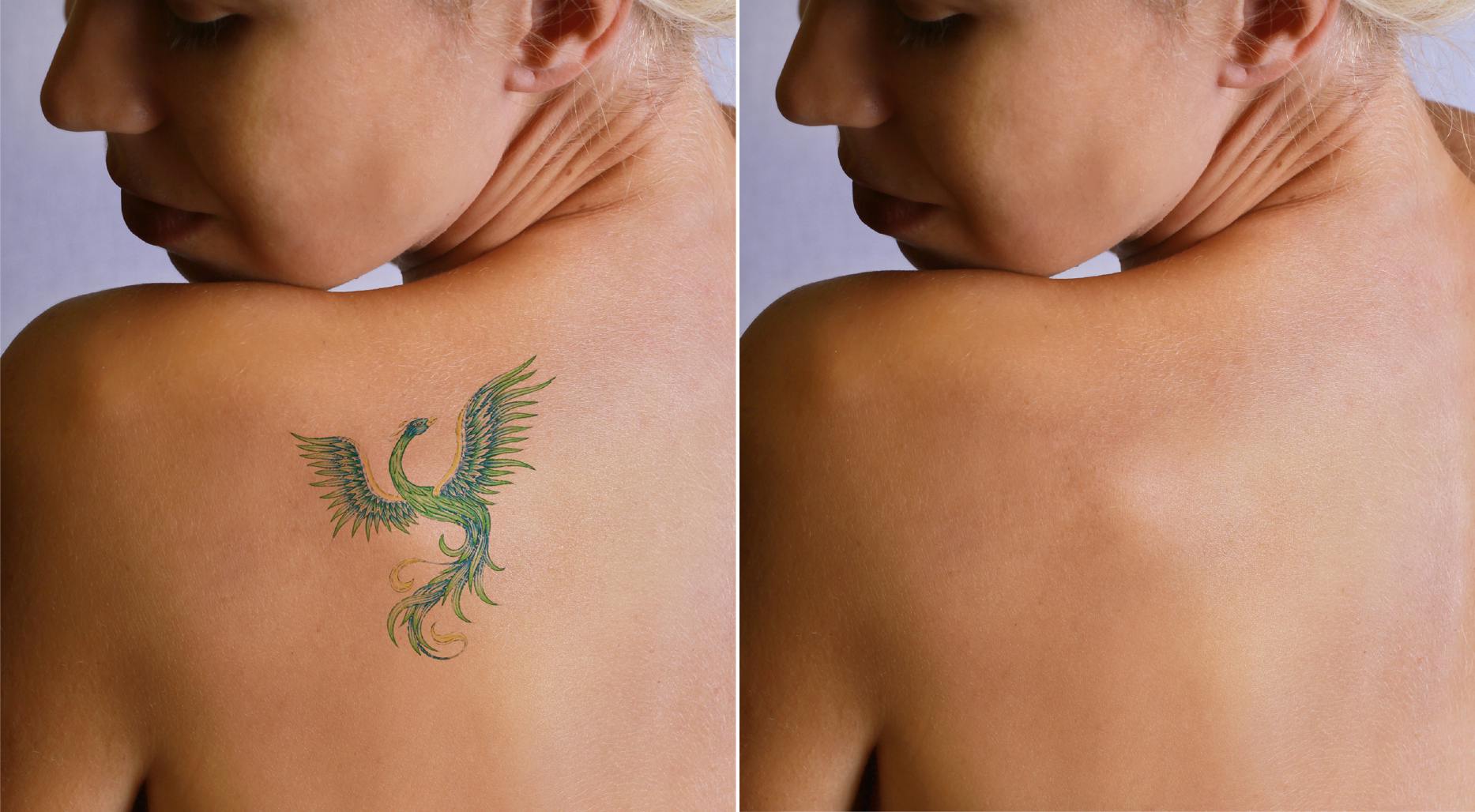 Enlever un tatouage au laser | Santé Magazine