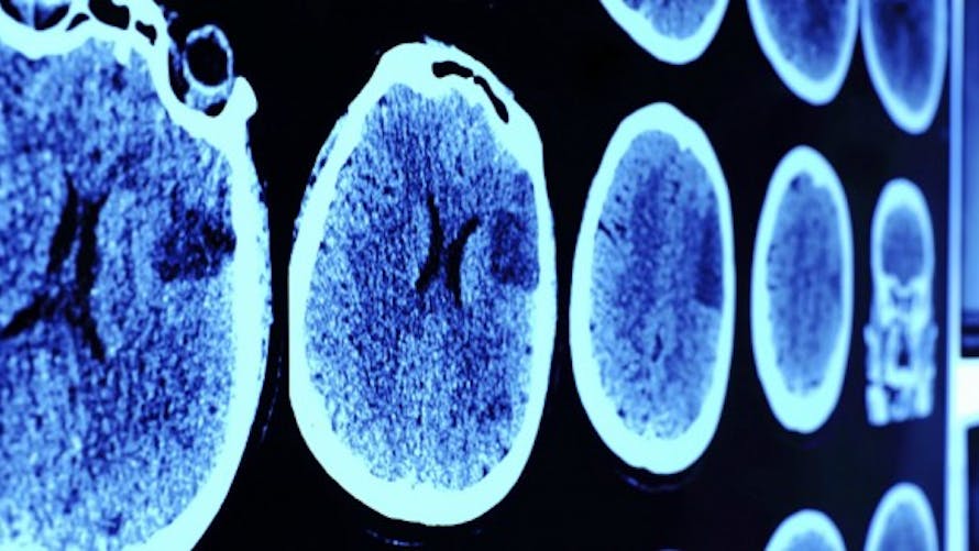 Alzheimer : des chercheurs évoquent la piste des anti-inflammatoires