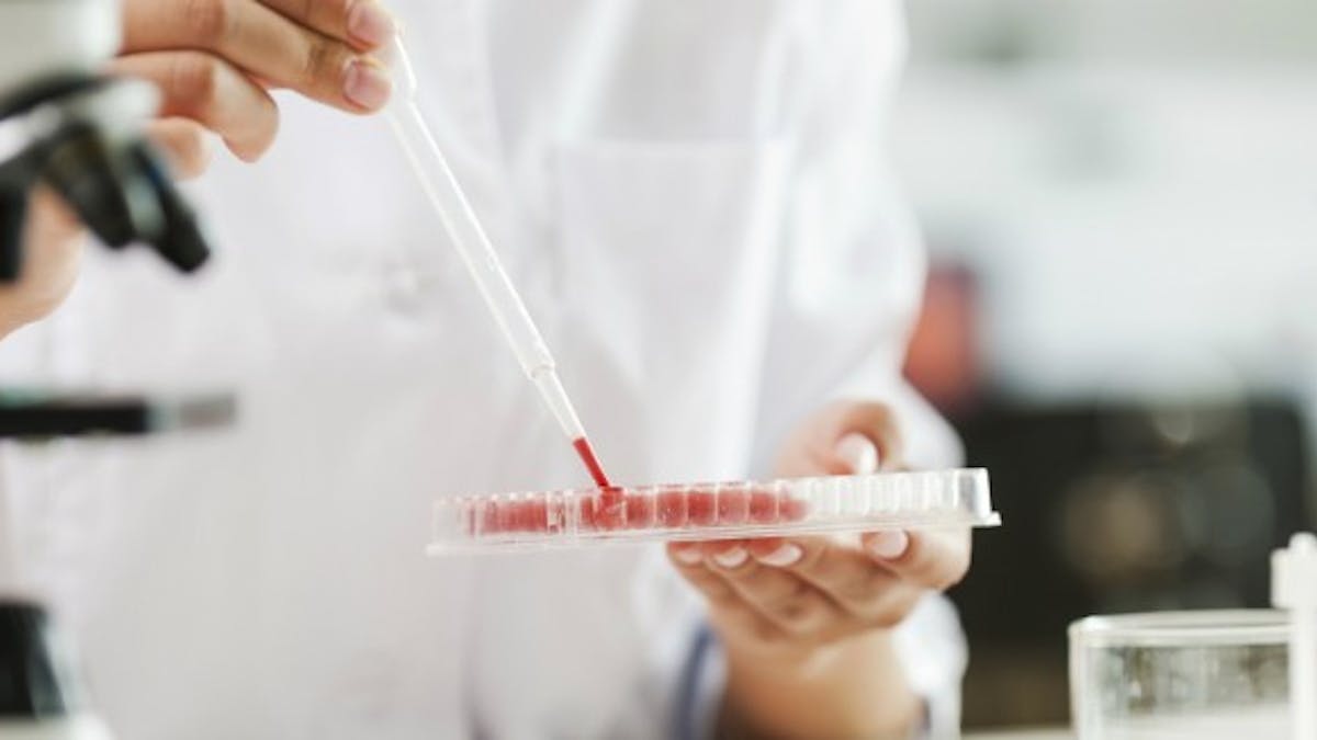 Cancer du poumon : un test sanguin pour mieux évaluer la réponse à la chimiothérapie