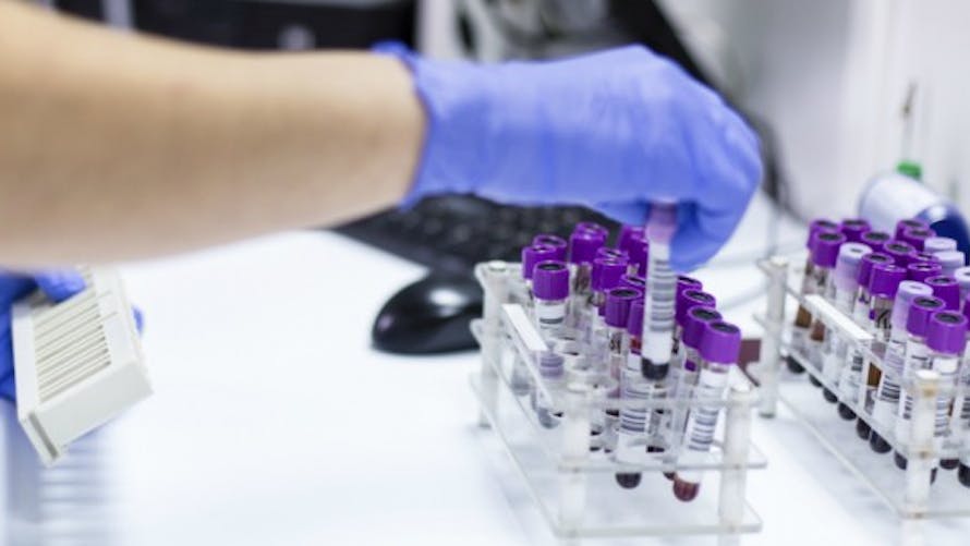 Un test sanguin de routine prédit la durée de survie des patients atteints d'un cancer