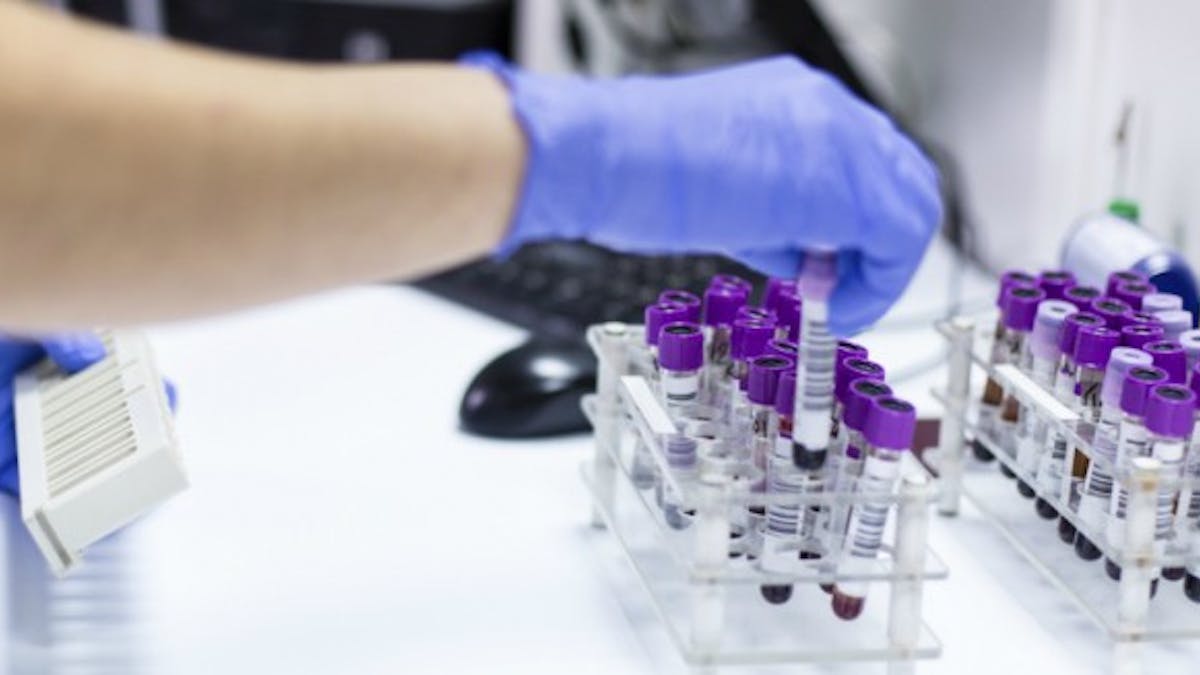Un test sanguin de routine prédit la durée de survie des patients atteints d'un cancer