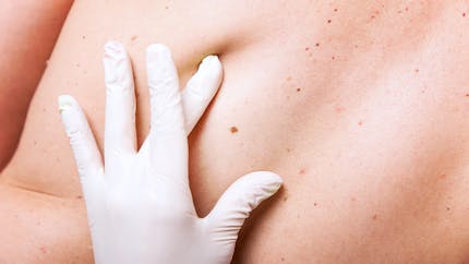 Boutons dans le dos : comment traiter ce type d'acné ? 