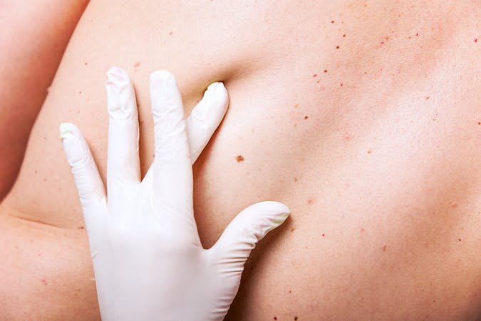 Comment se débarrasser des boutons d’acné dans le dos ?