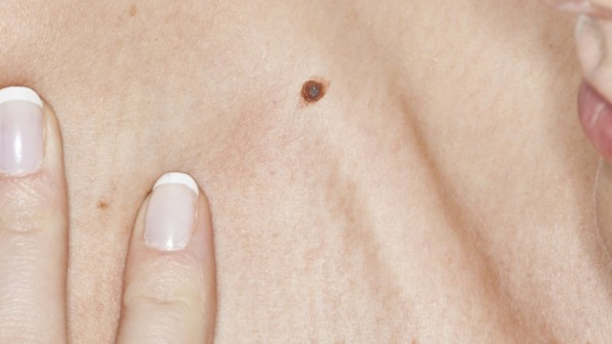 Comment Un Grain De Beaute Se Transforme T Il En Melanome Sante Magazine Comment Un Grain De Beaute Se Transforme T Il En Melanome Sante Magazine