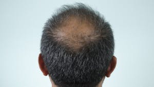 4 mythes sur la perte de cheveux