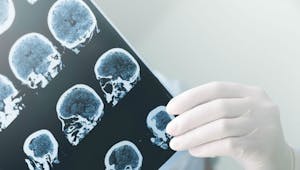 Maladie d'Alzheimer : les avantages de la tomographie par émission de positrons