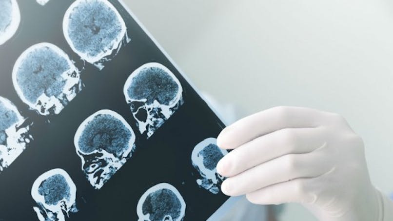 Maladie d'Alzheimer : les avantages de la tomographie par émission de positrons