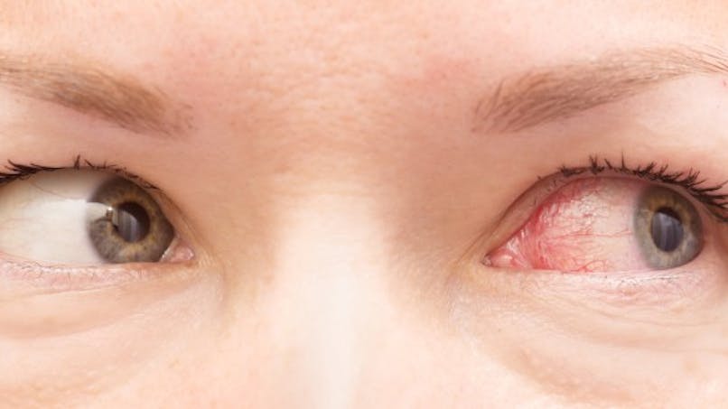 Allergies : symptôme et traitement. 25 à 30% de français sont ...