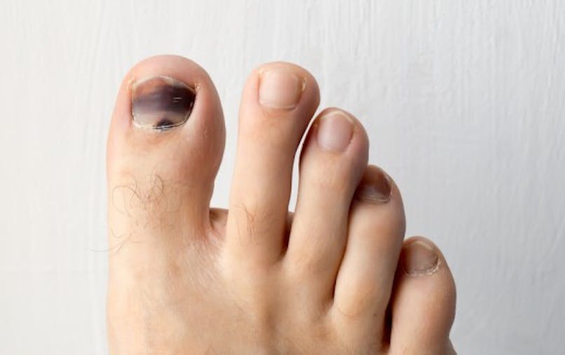 Comment Soigner Un Ongle Noir Sante Magazine Comment Soigner Un Ongle Noir Sante Magazine