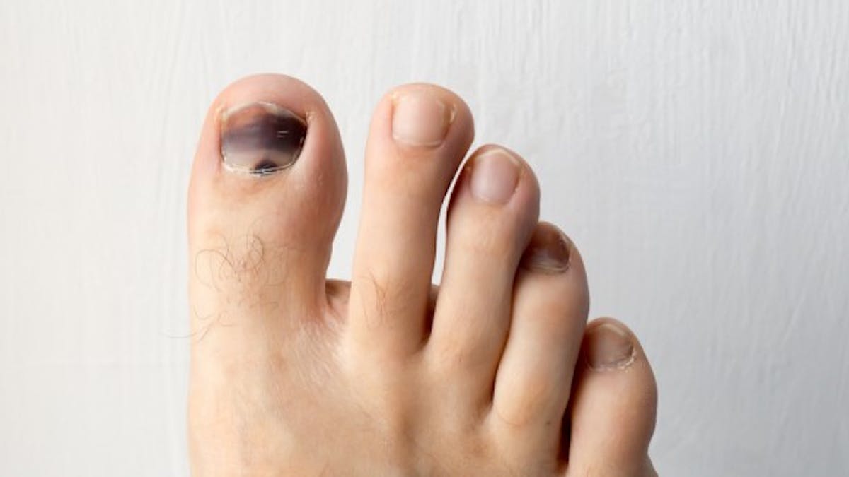 Comment Soigner Un Ongle Noir Sante Magazine Comment Soigner Un Ongle Noir Sante Magazine