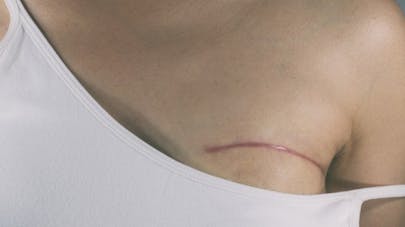 4 choses à savoir sur les cicatrices d'une mastectomie