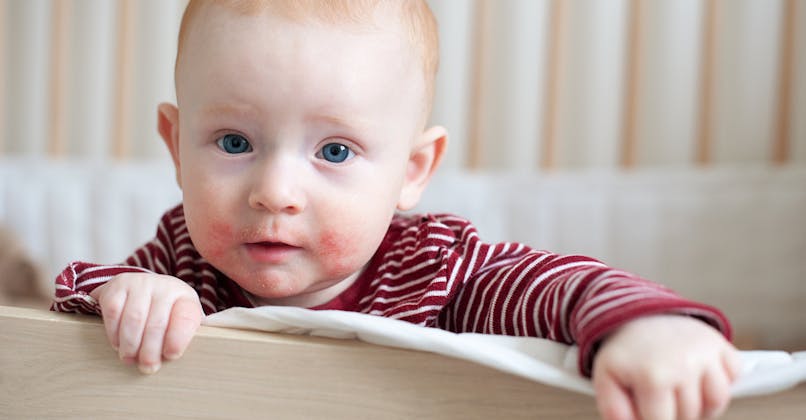 Allergie Chez Le Bebe Identifier Et Traiter Sante Magazine Allergie Chez Le Bebe Identifier Et Traiter Sante Magazine