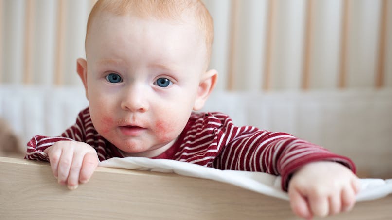 Allergie Chez Le Bebe Identifier Et Traiter Sante Magazine Allergie Chez Le Bebe Identifier Et Traiter Sante Magazine