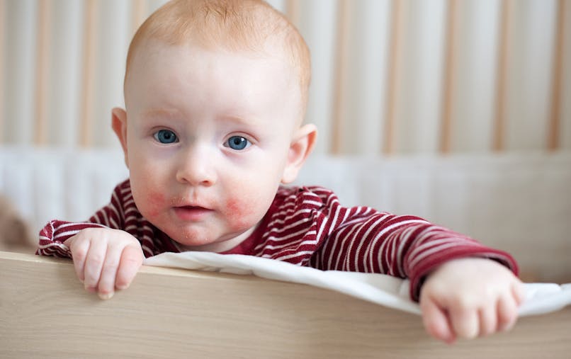 Allergie Chez Le Bebe Identifier Et Traiter Sante Magazine Allergie Chez Le Bebe Identifier Et Traiter Sante Magazine