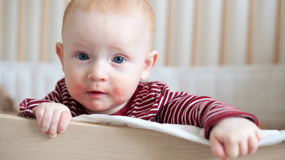 Allergie Chez Le Bebe Identifier Et Traiter Sante Magazine Allergie Chez Le Bebe Identifier Et Traiter Sante Magazine