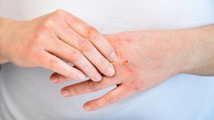 4 mythes sur les allergies cutanées