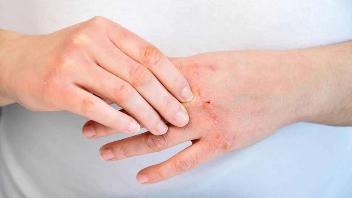 Allergie Cutanee De Quoi S Agit Il Exactement Sante Magazine
