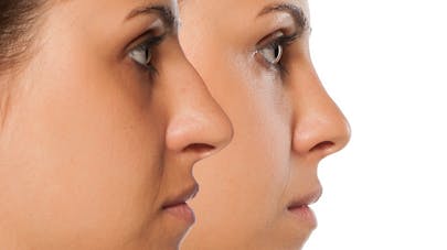Rhinoplastie Medicale Sans Chirurgie Comment Ca Fonctionne Sante Magazine
