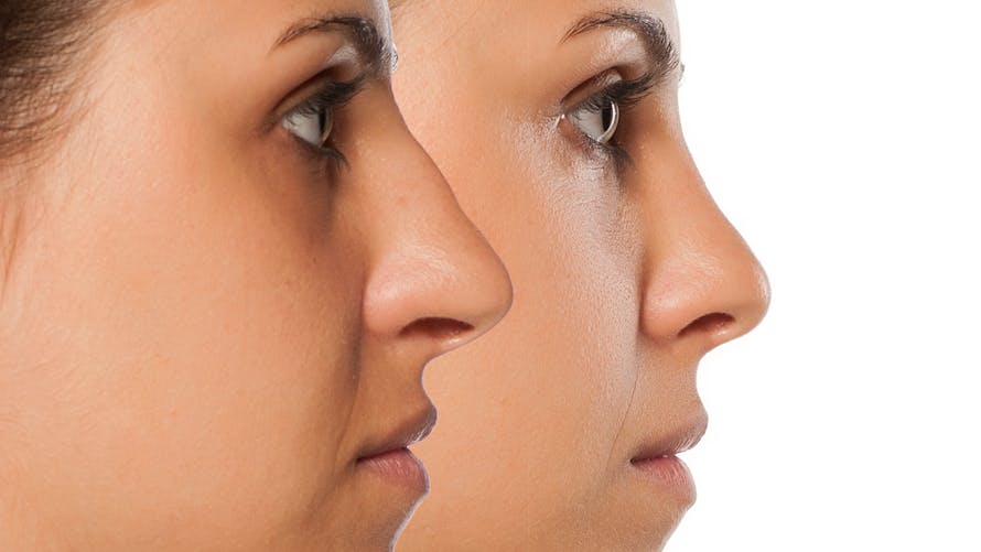 Rhinoplastie médicale sans chirurgie : comment ça fonctionne ? | Santé Magazine