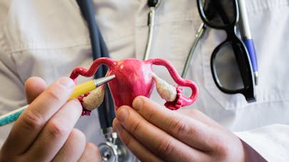 5 mythes sur l'endométriose