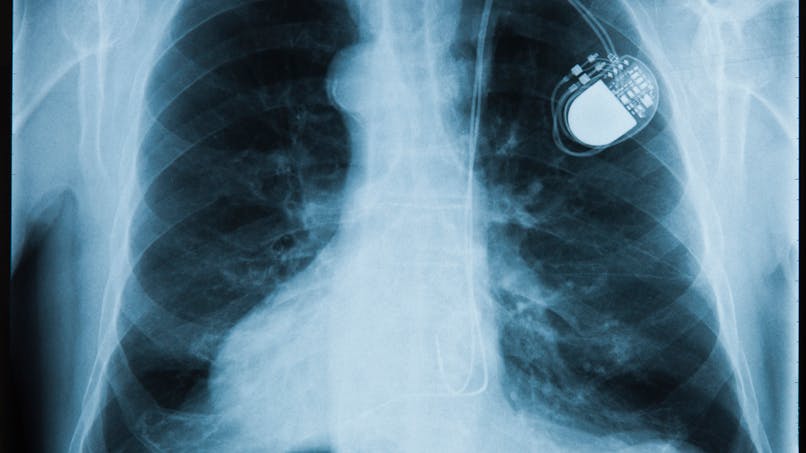 «Implant Files» : 5 choses à savoir sur les dispositifs médicaux