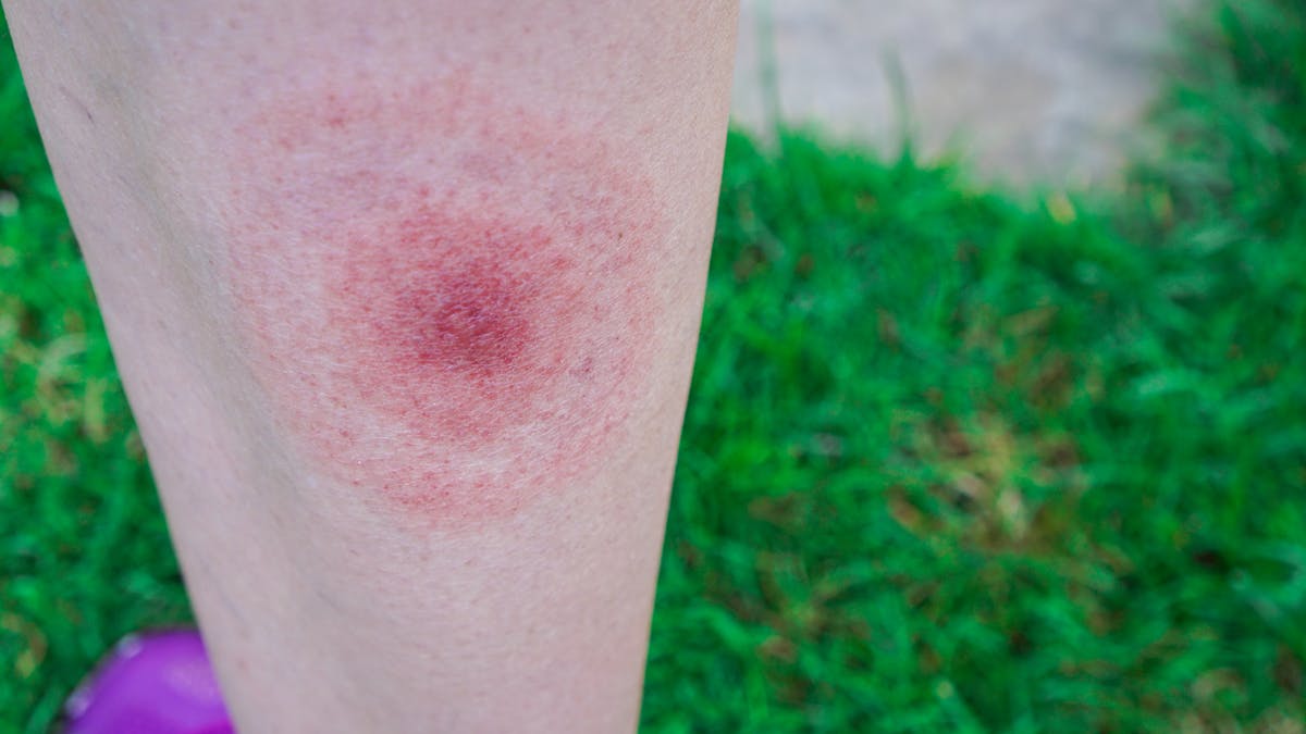Maladie de Lyme : l’éruption cutanée suffit à la diagnostiquer