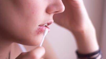 Tout savoir sur les boutons de fièvre à répétition