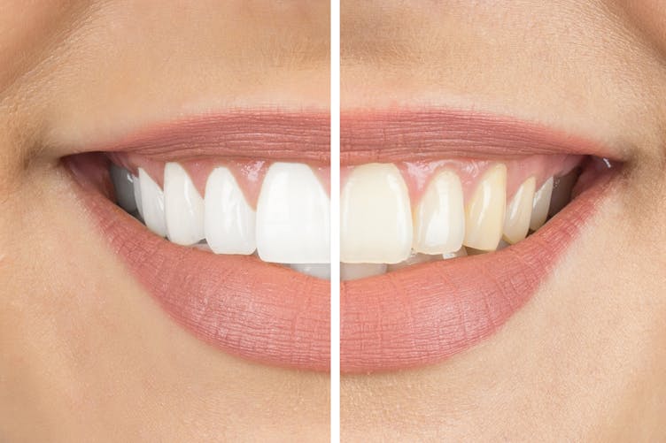 Blanchiment des dents : les produits en vente libre éroderaient les dents jusqu’au nerf