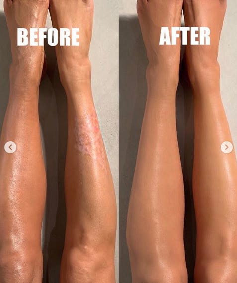 Psoriasis Kim Kardashian