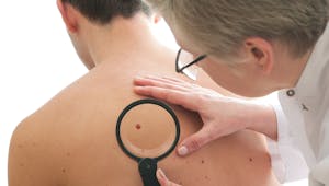 Cancer de la peau : quels traitements ? 