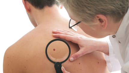 Cancer de la peau : quels traitements ? 