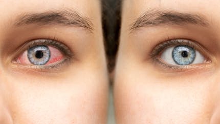 6 raisons qui expliquent les yeux rouges