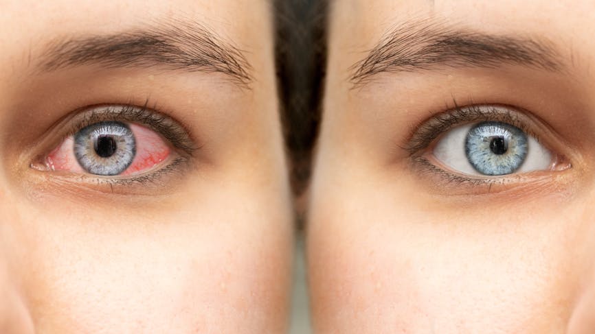 6 raisons qui expliquent les yeux rouges