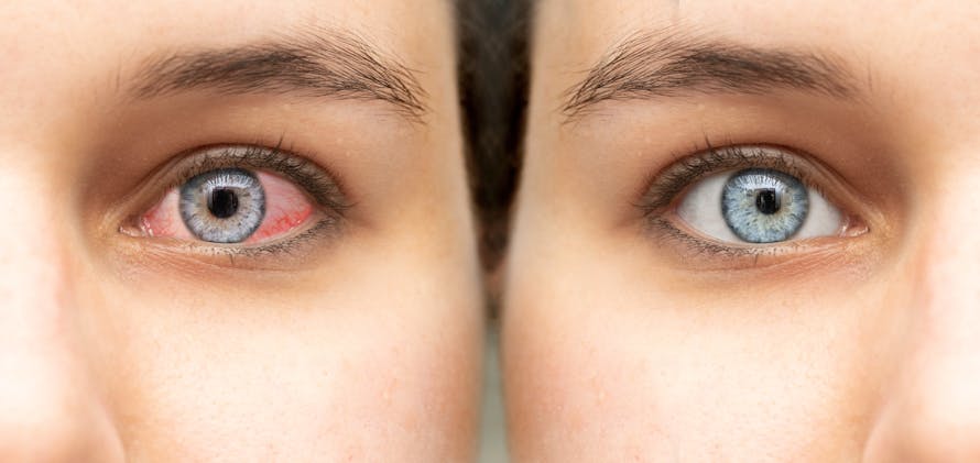 5 raisons qui peuvent expliquer les yeux rouge et quelques solutions
