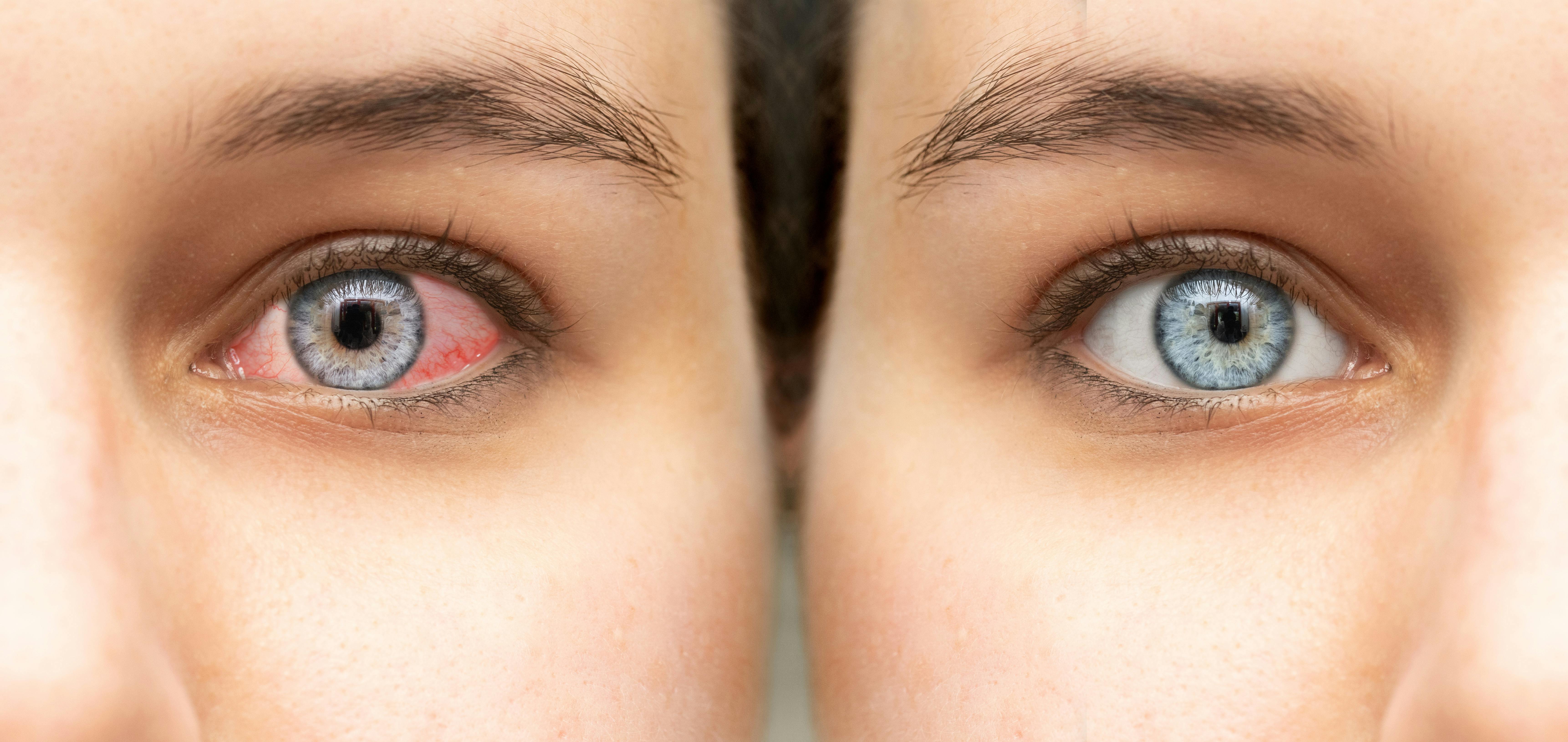 6 raisons qui expliquent les yeux rouges sante magazine
