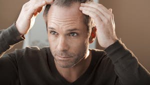 Chute de cheveux : nouvelle mise en garde contre les effets indésirables du finastéride