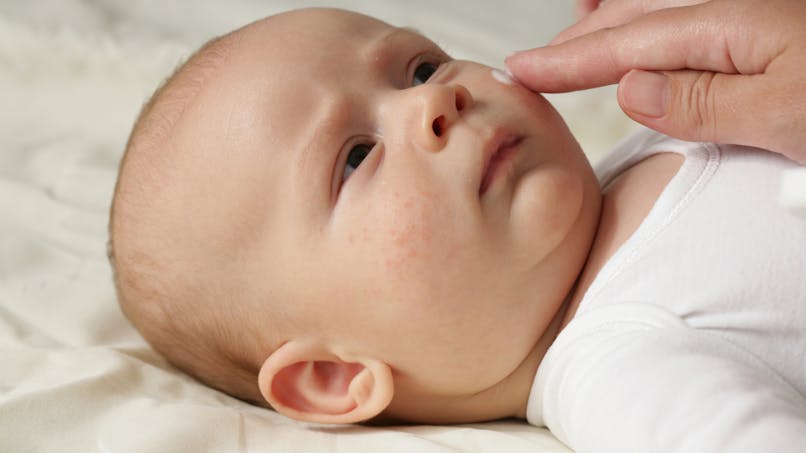 Bébé : l’utilisation quotidienne d’émollient n’empêche pas l’apparition d’eczéma