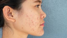Comment faire disparaître les cicatrices d’acné ?
