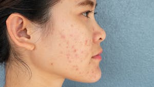 Cicatrices d’acné : comment retrouver une belle peau